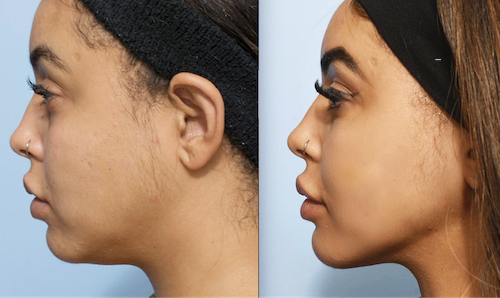 Double Chin Treatment Results Mississauga Oakville